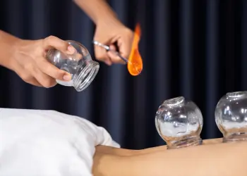 Fire Cupping